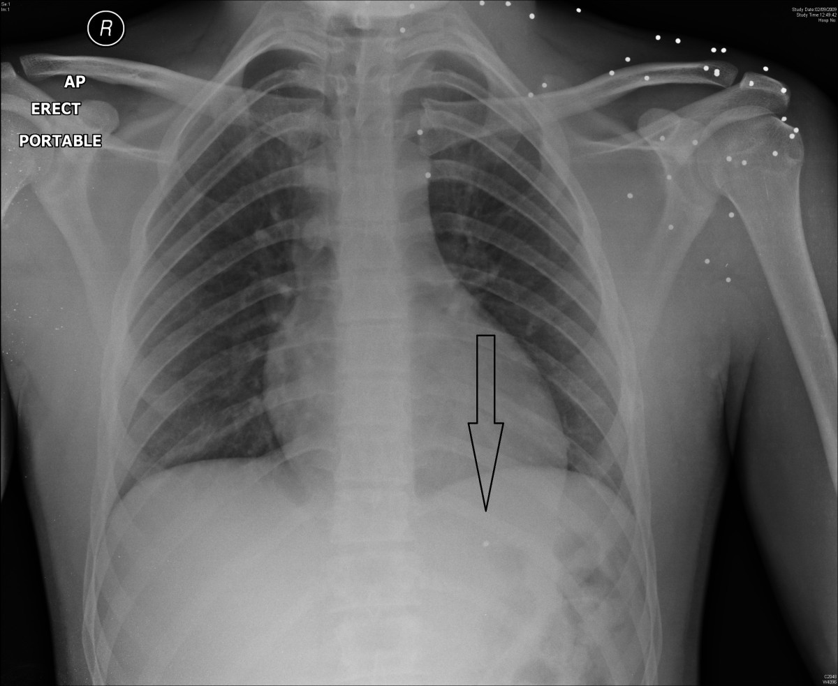 Gunshot bullet embolus with pellet migration from the left brachiocephalic vein to the right