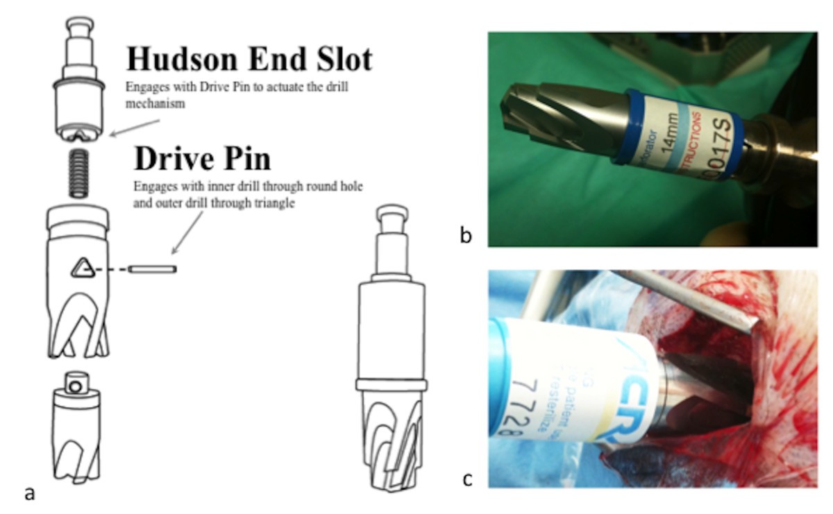Emergency burr holes "How to do it" Scandinavian Journal of Trauma