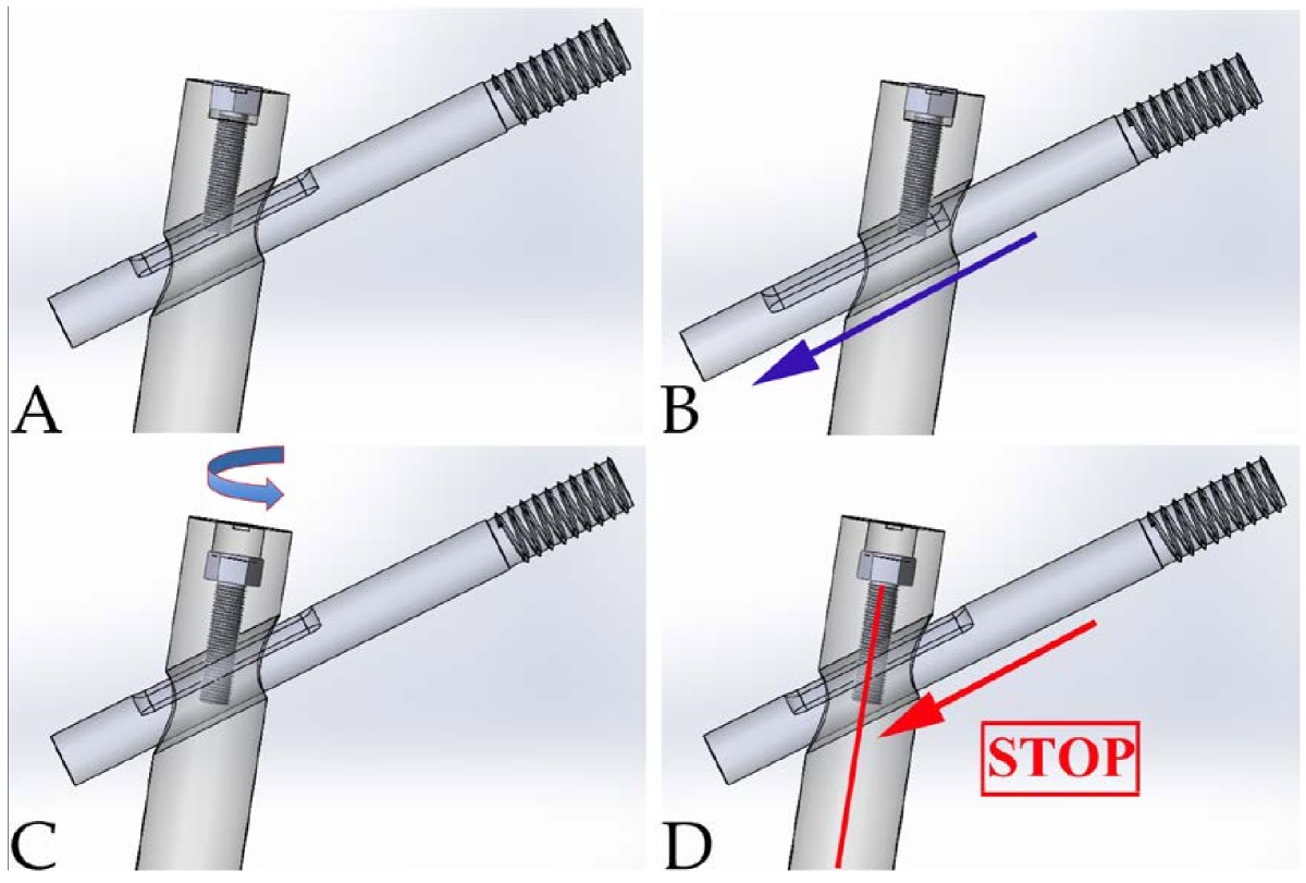 Is the lag screw sliding effective in the intramedullary nailing in A1