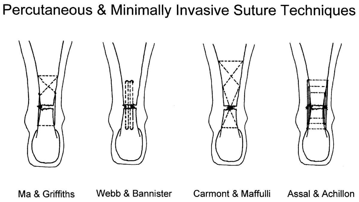 Percutaneous & Mini Invasive Achilles tendon repair BMC Sports