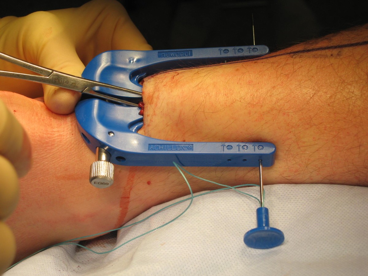 Percutaneous Mini Invasive Achilles Tendon Repair Bmc Sports Science Medicine And