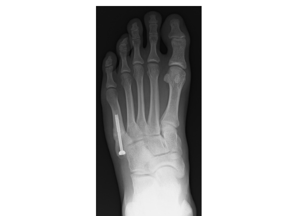 Intramedullary screw fixation with bone autografting to treat proximal