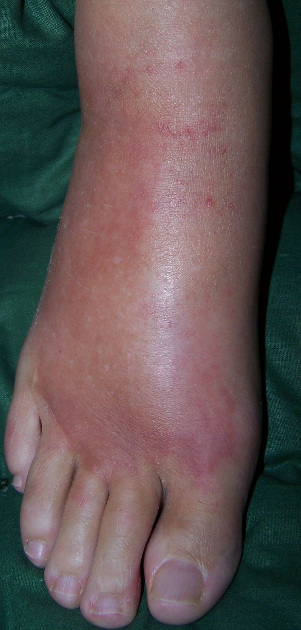 Sudeck's disease stage 1, or diabetic Charcot's foot stage