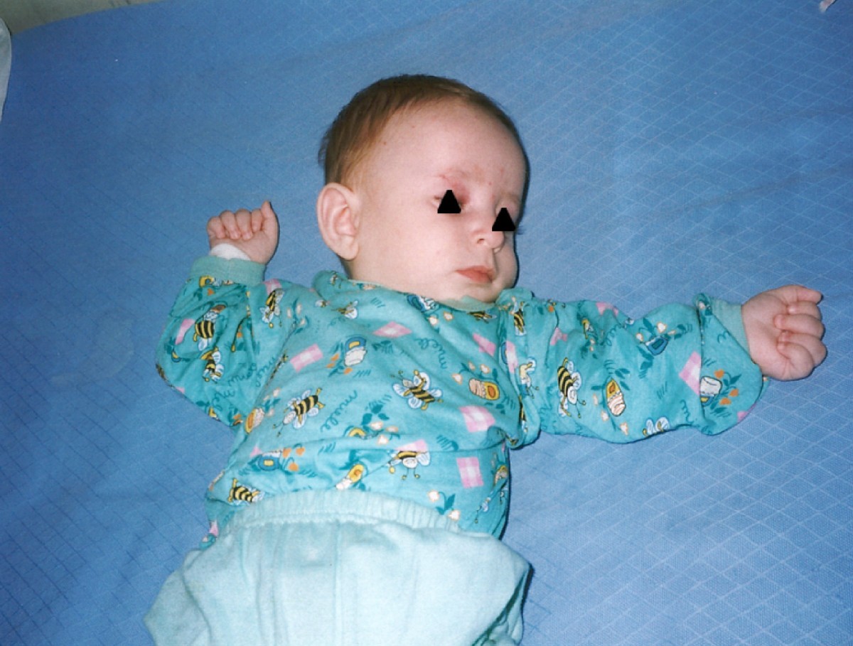 Epilepsy in patients with Angelman syndrome Italian