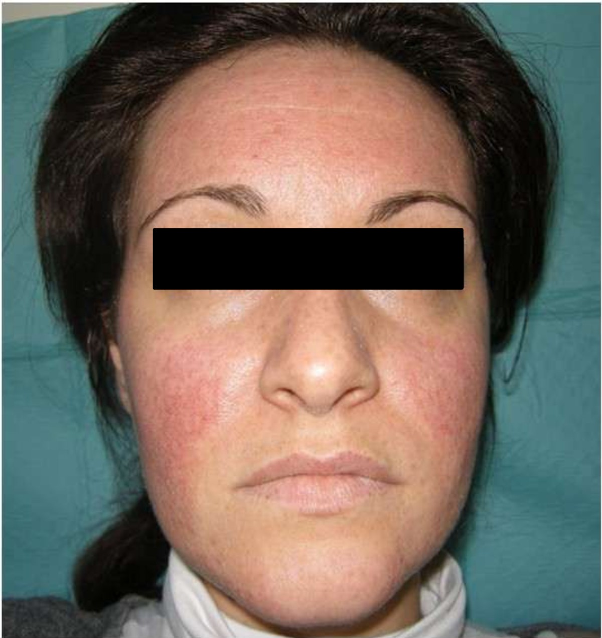 Rosacea-like facial ra...