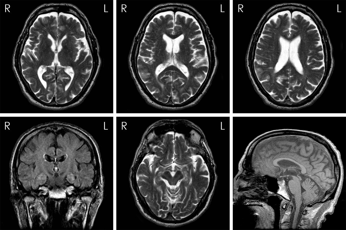 progressive supranuclear palsy and chronic traumatic encephalopathy in a boxer