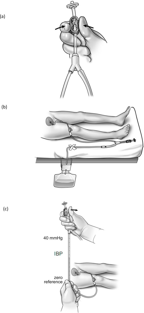 Intraabdominal pressure measurement using the FoleyManometer does not