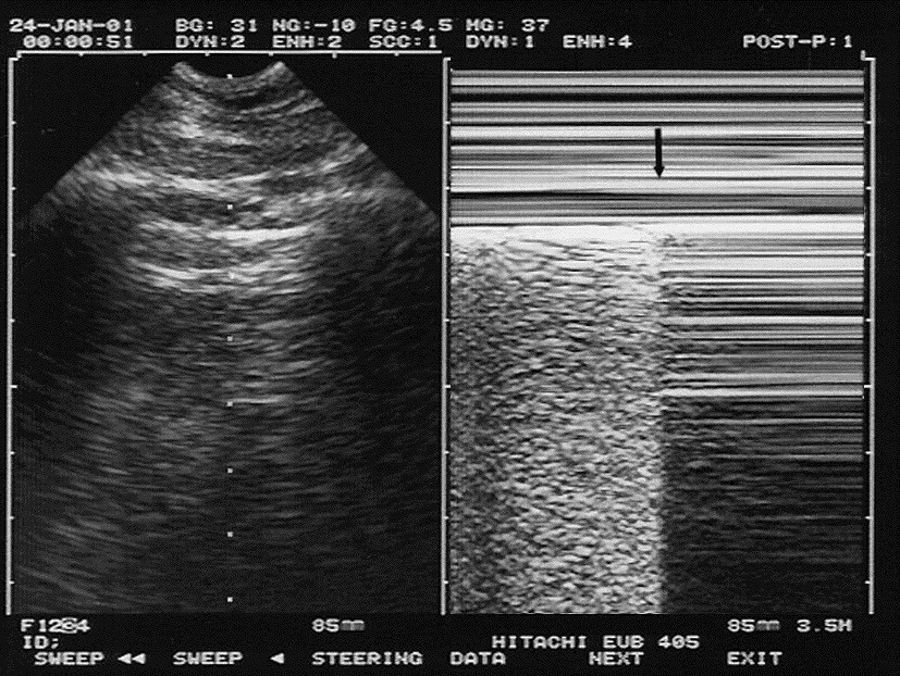 M Mode Sono M Mode Sono