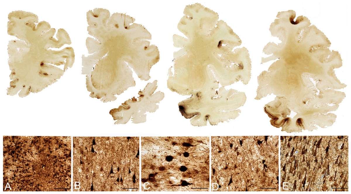 Chronic Traumatic Encephalopathy: A Spectrum Of Neuropathological ...