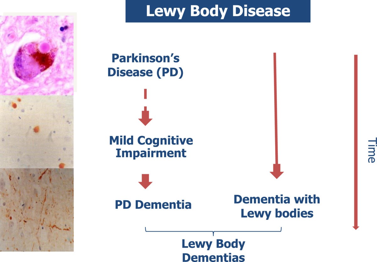 research paper on lewy body dementia