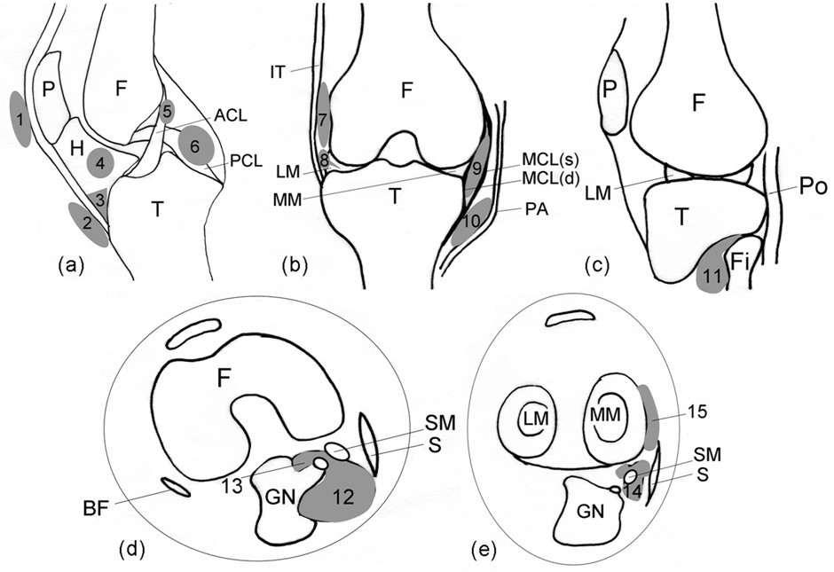 Longitudinal assessment of cyst-like lesions of the knee ... acl mcl diagram 