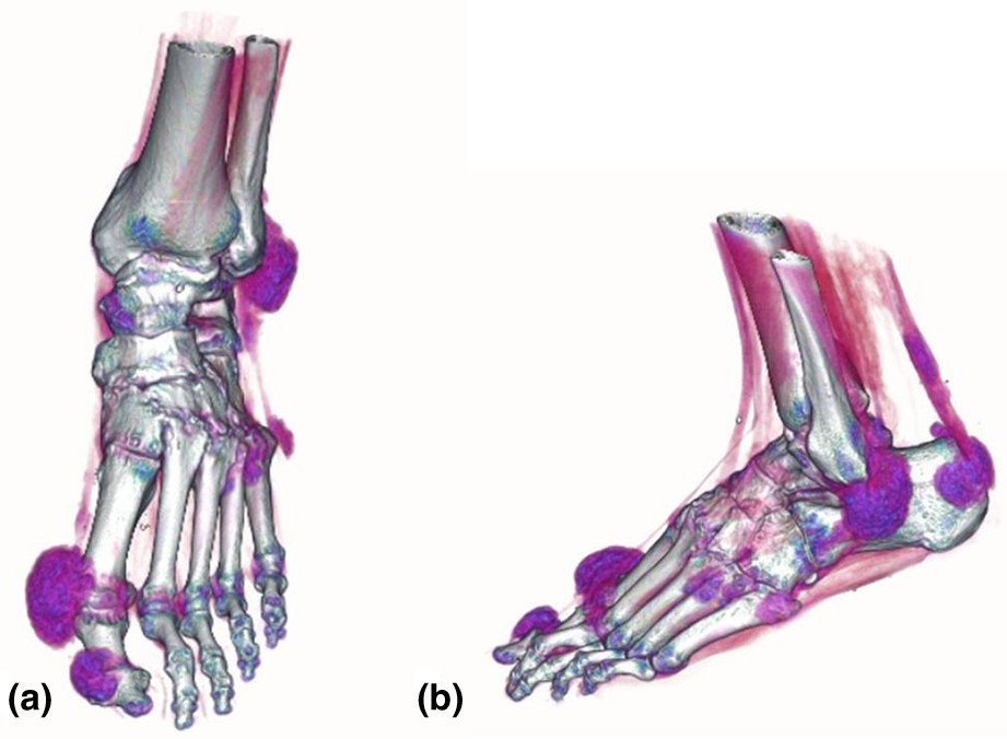Imaging in gout What can we learn from MRI, CT, DECT and US