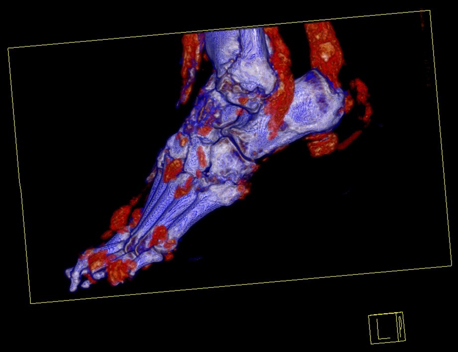 Imaging in gout What can we learn from MRI, CT, DECT and US