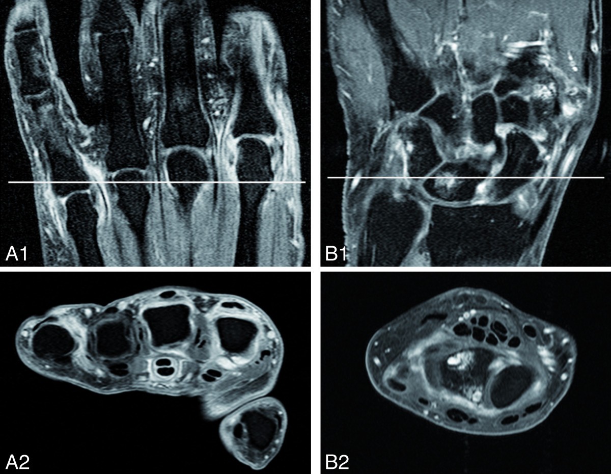 Subclinical inflammation on MRI of hand and foot of anticitrullinated
