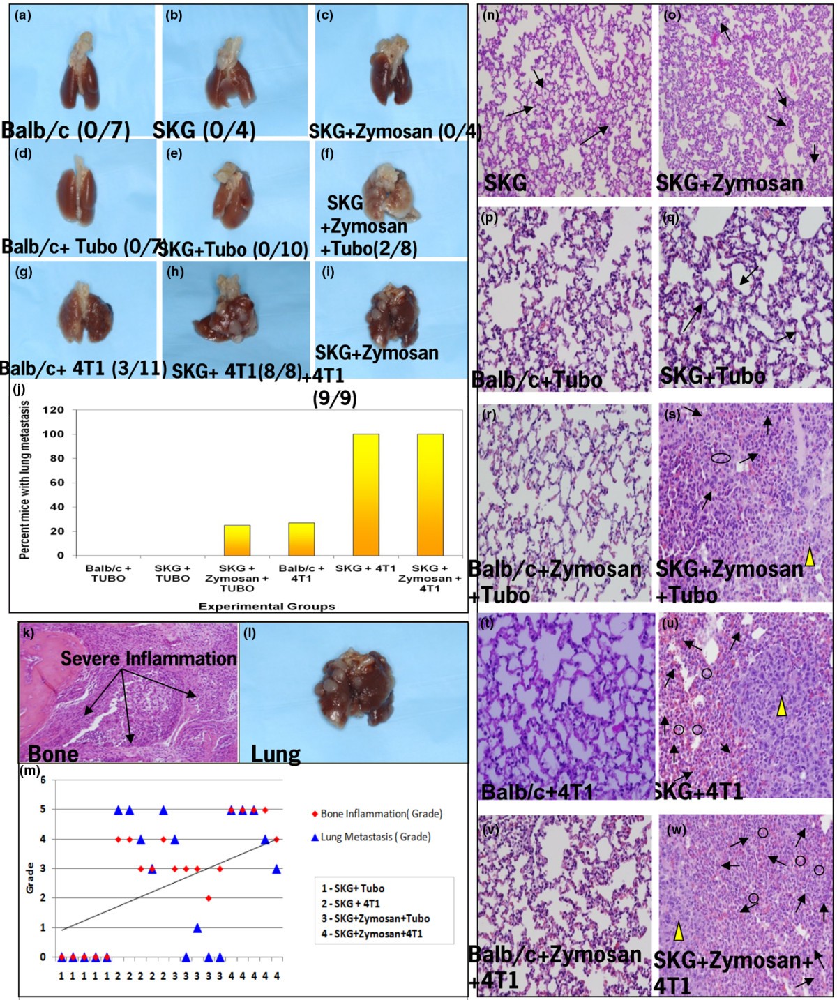 Breast cancerassociated metastasis is significantly increased in a model of autoimmune