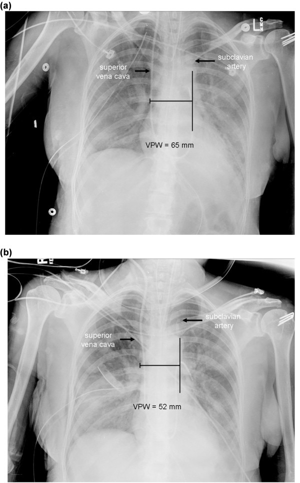 Vascular pedicle width in acute lung injury correlation with