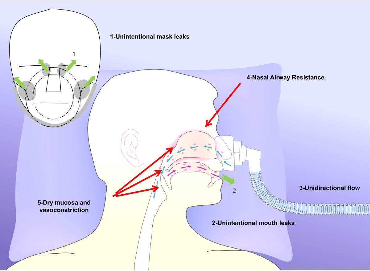 Clinical review Humidifiers during noninvasive ventilation key