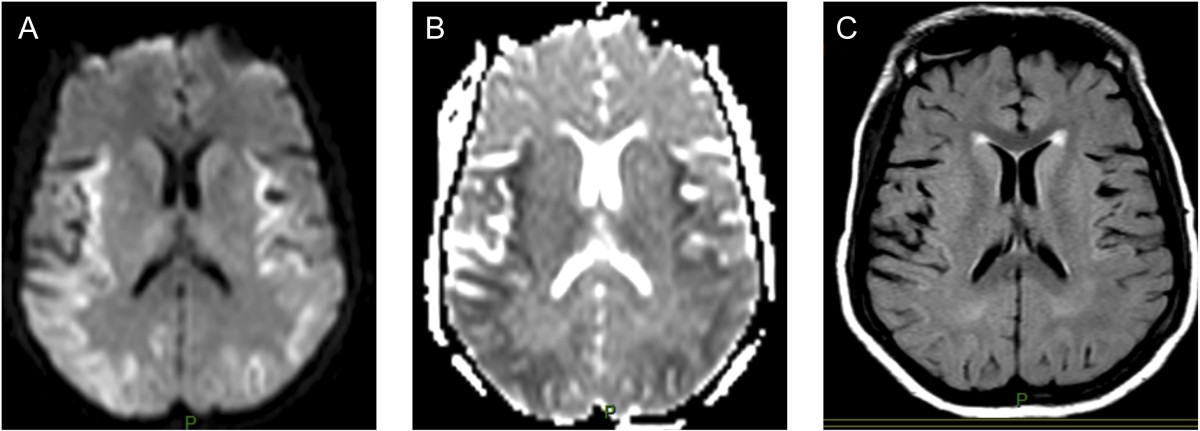 Pattern of Brain Injury in the Acute Setting of Human Septic Shock ...