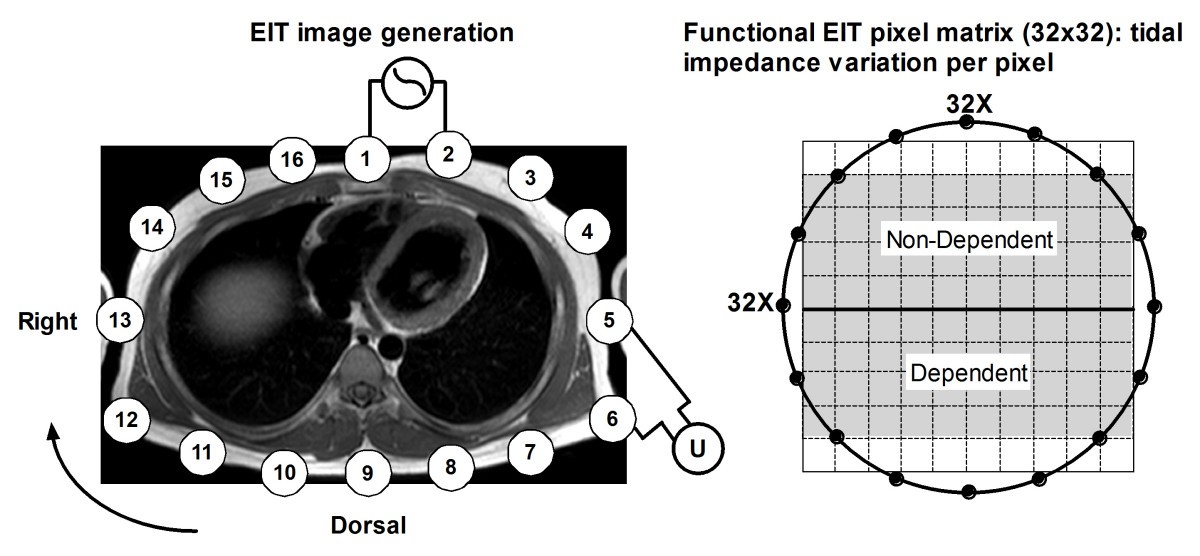 Bedside measurement of changes in lung impedance to monitor alveolar