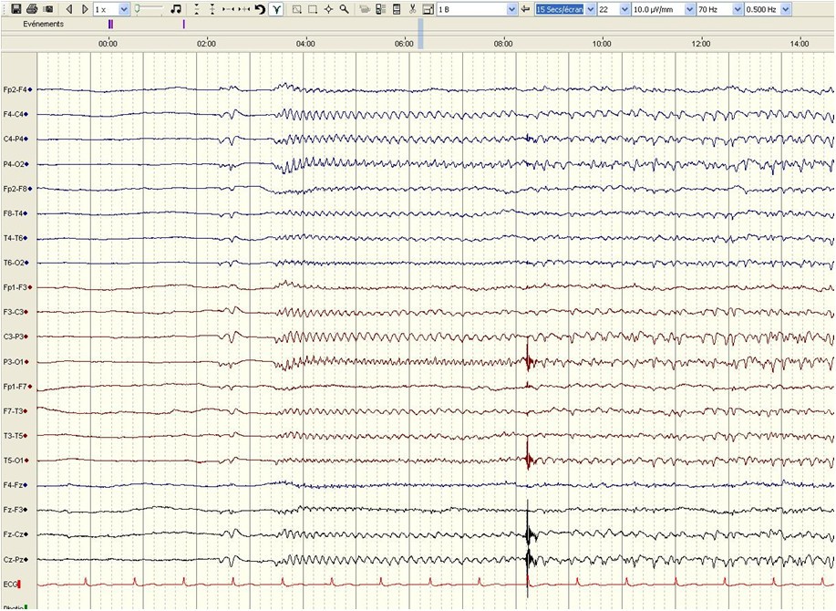 Prognostic value of continuous EEG monitoring during therapeutic
