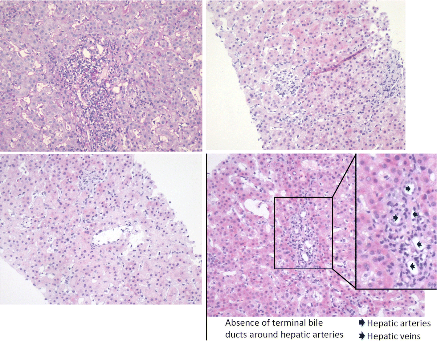 Vanishing bile duct syndrome with hyperlipidemia after ibuprofen