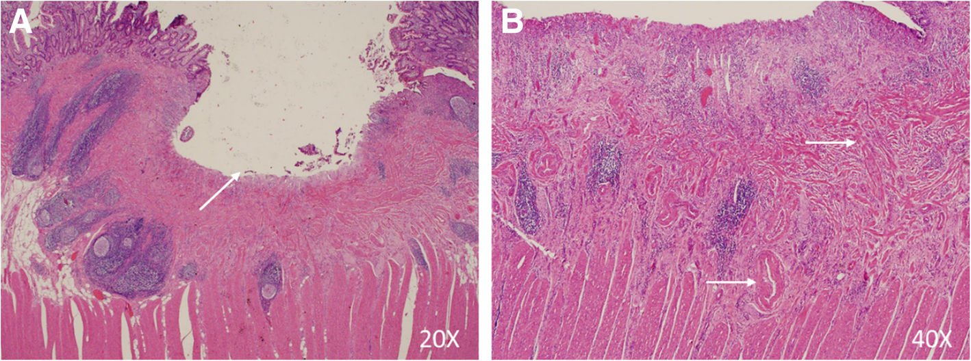 Case Report Of Cryptogenic Multifocal Ulcerous Stenosing Enteritis
