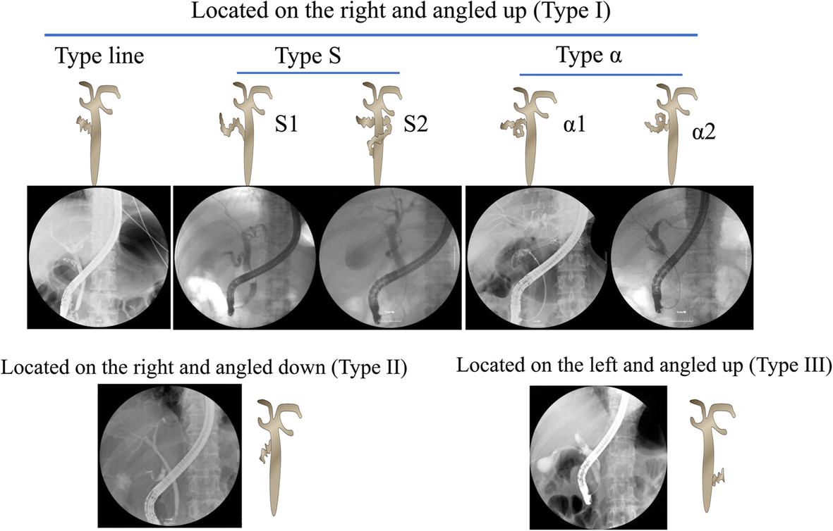 Classification of the cystic duct patterns and endoscopic