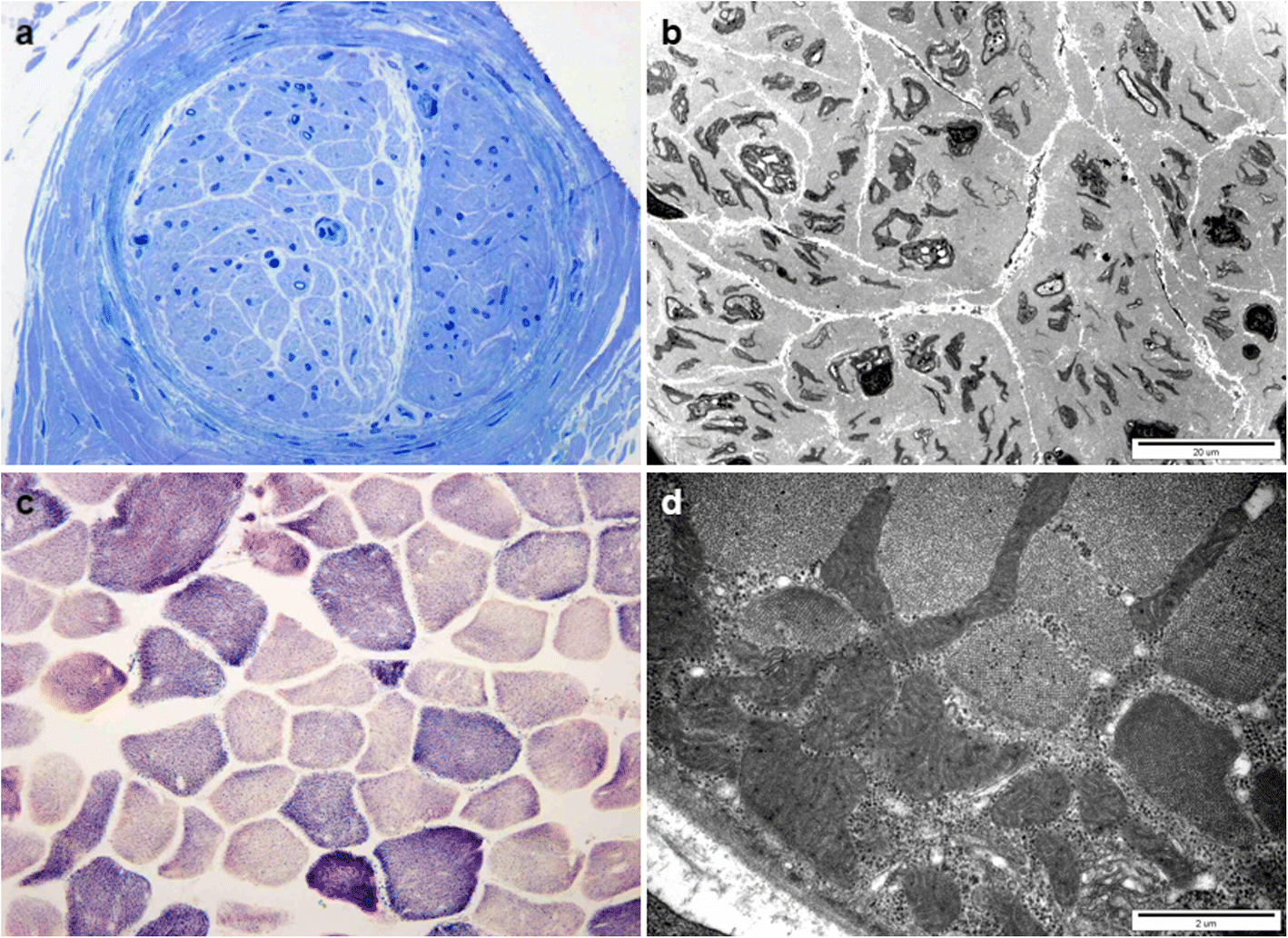 A novel homozygous MPV17 mutation in two families with axonal