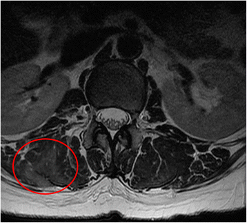 A case report of thoracolumbar paraspinal myopathy as the cause of