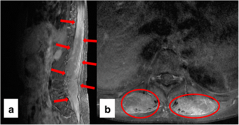 A case report of thoracolumbar paraspinal myopathy as the cause of