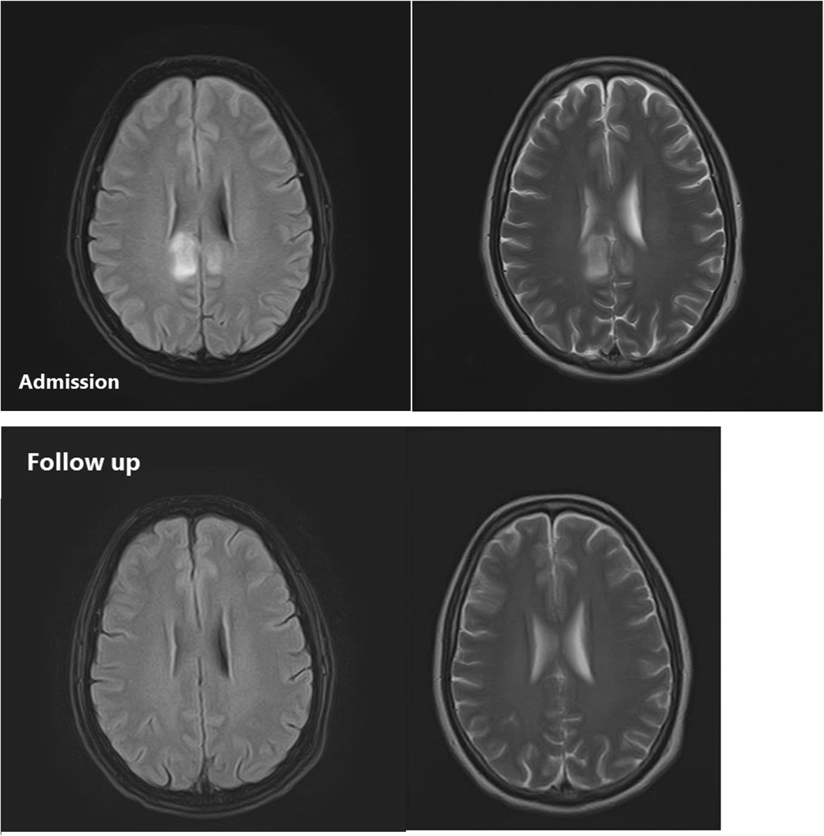Encephalopathy following ingestion of Leadcontaminated opium;