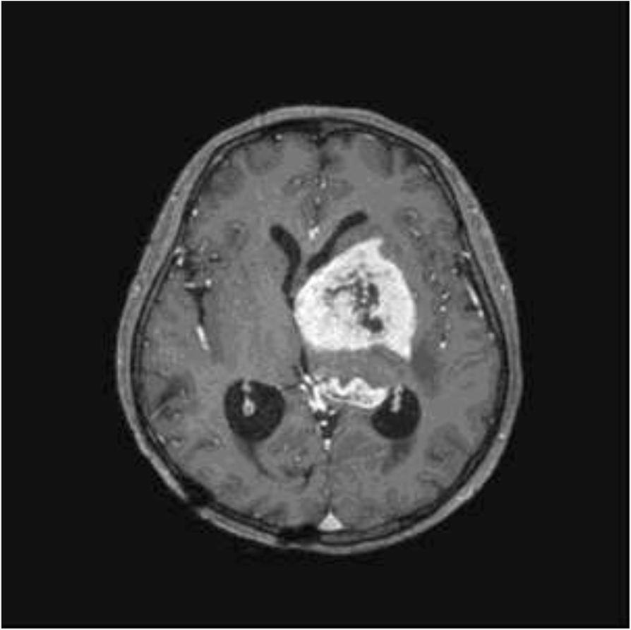Secondary glioblastoma after treatment of intracranial germinoma