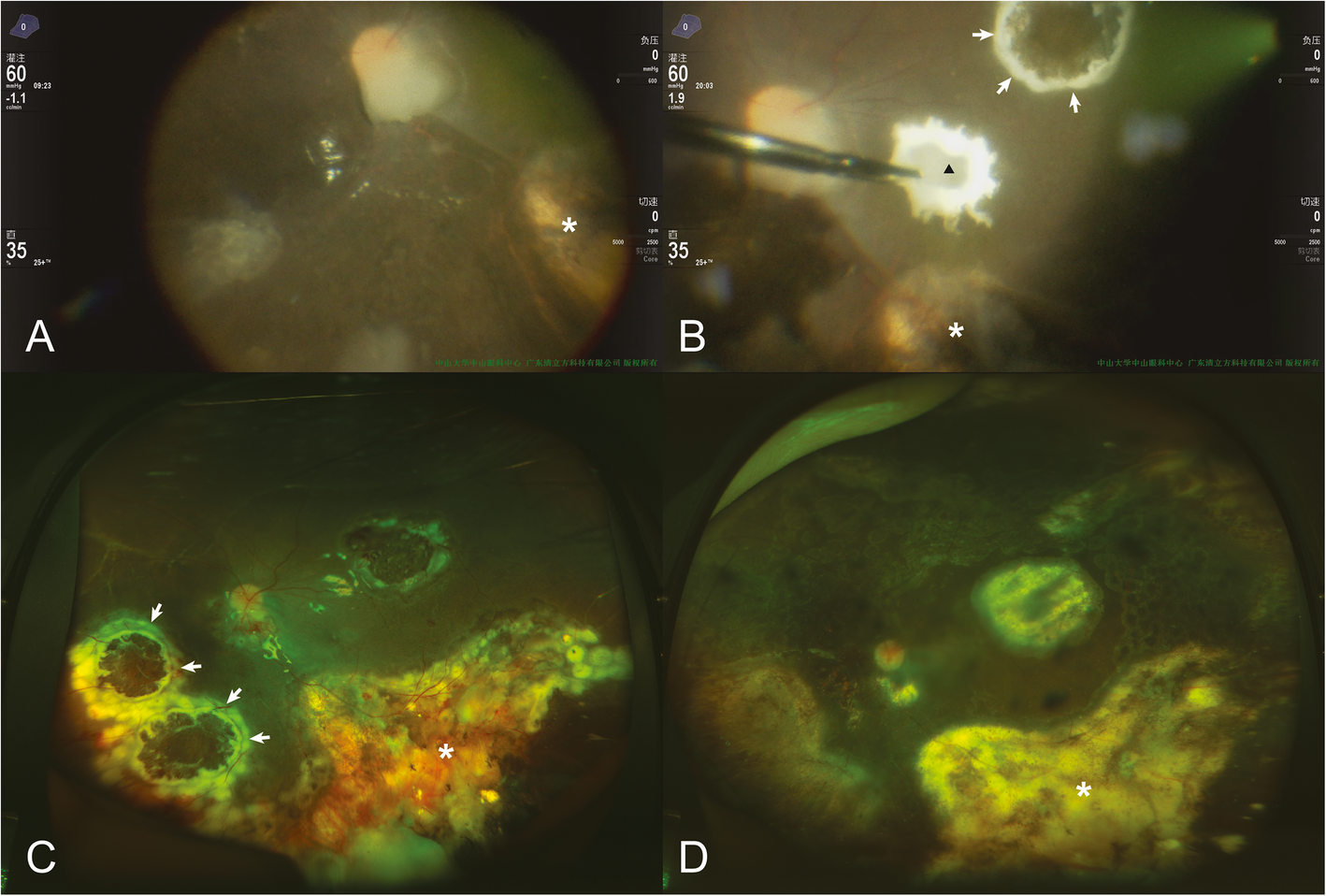 Effectiveness of intravitreal chemotherapyassisted endoresection in