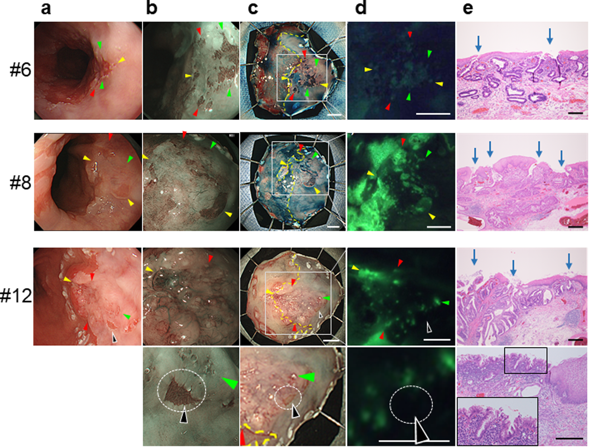 Detection Of Early Adenocarcinoma Of The Esophagogastric Junction By 