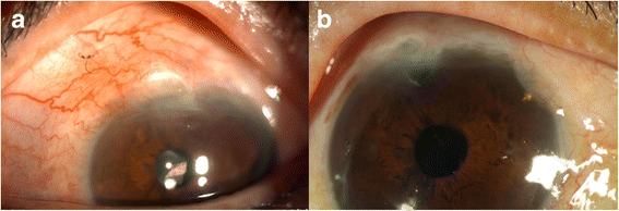 ExPRESS miniature glaucoma shunt for intractable secondary glaucoma in