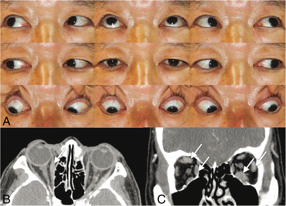 IgG4related ophthalmic disease involving extraocular muscles case