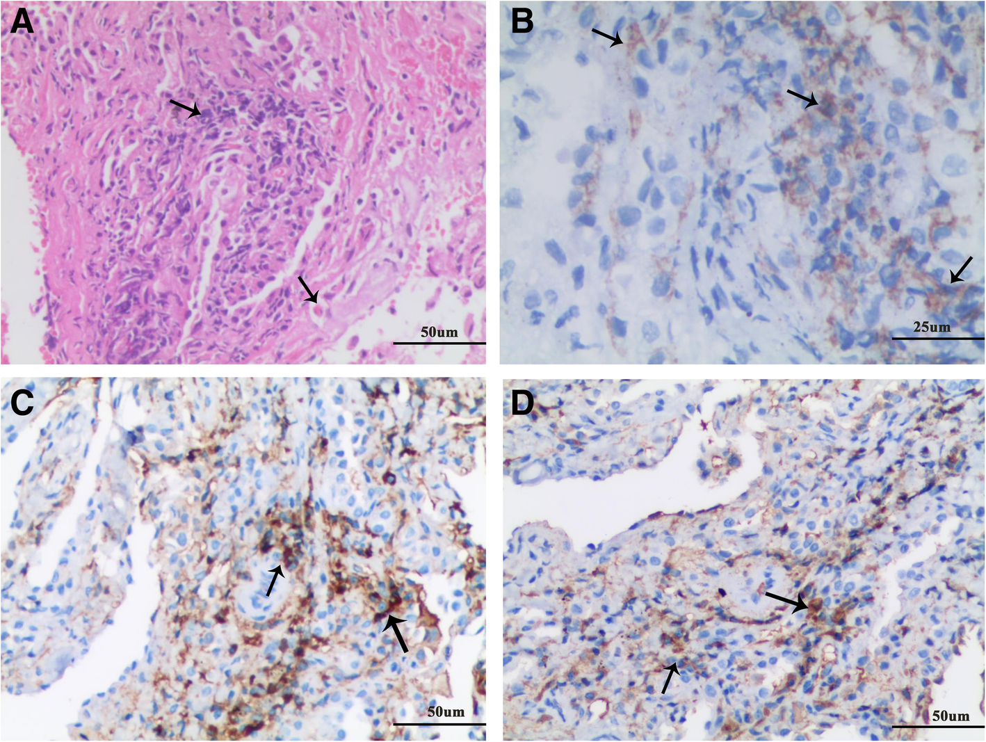 A Case Of Eosinophilic Granulomatosis With Polyangiitis Complicated