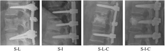 Treatment of thoracolumbar burst fractures by short-segment pedicle