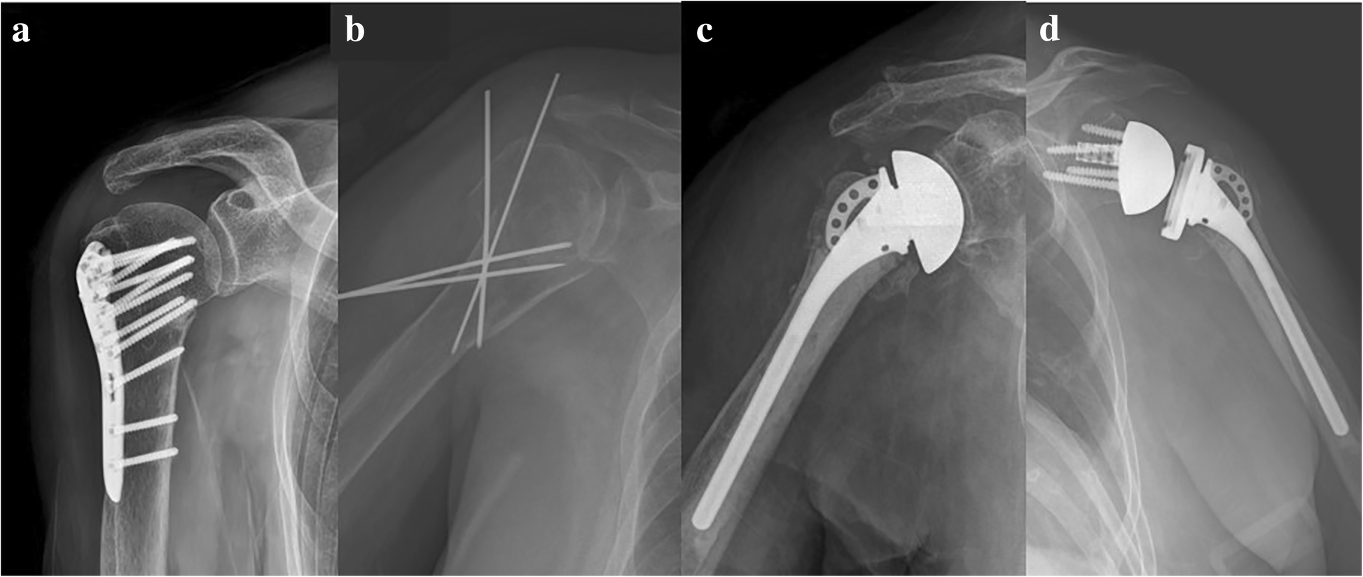 Surgical trends in elderly patients with proximal humeral