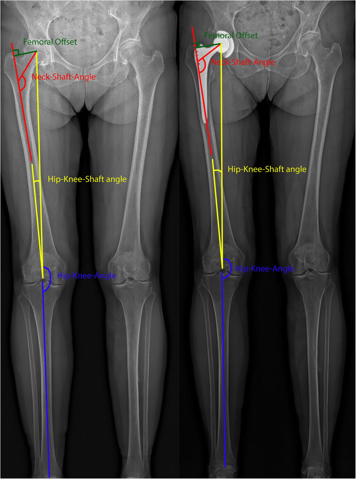 Are changes in radiological leg alignment and femoral parameters after