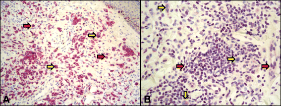 BAP1: case report and insight into a novel tumor ...