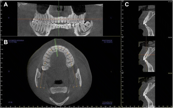 Anterior maxilla alveolar ridge dimension and morphology measurement by