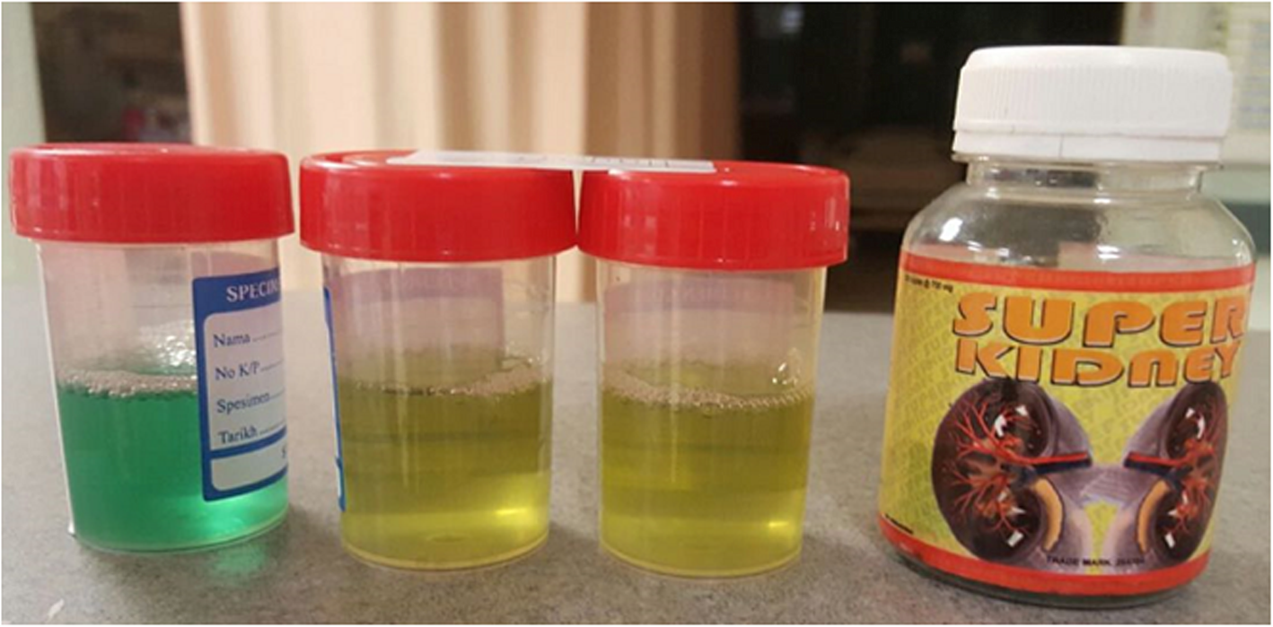 What Medication Can Cause Urine Discoloration