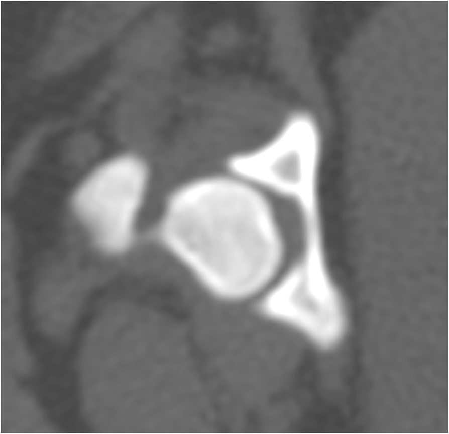 Evaluation of vacuum phenomenon in dogs with coxofemoral degenerative