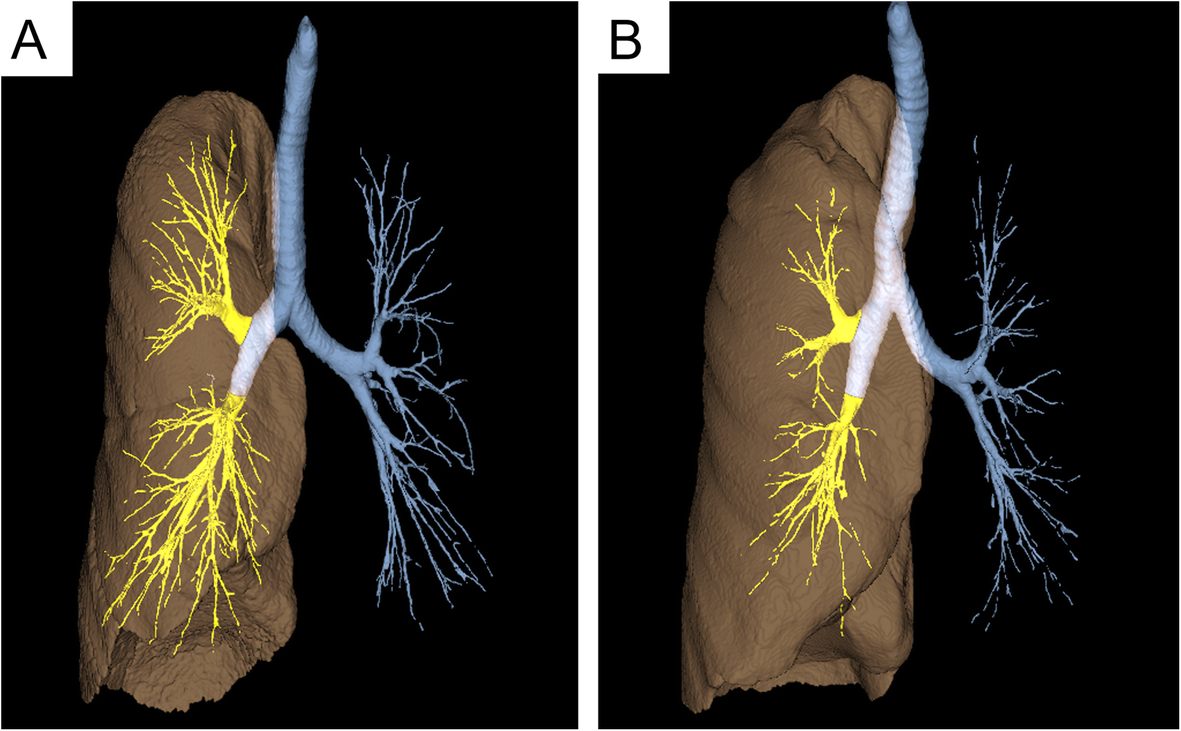 Associations of airway tree to lung volume ratio on computed tomography