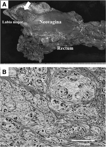 Mucinous adenocarcinoma emerging in sigmoid colon ...
