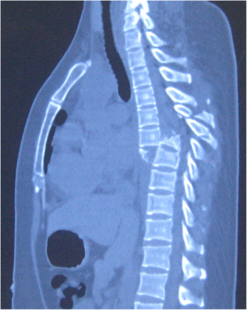 Severe fracture-dislocation of the thoracic spine without any