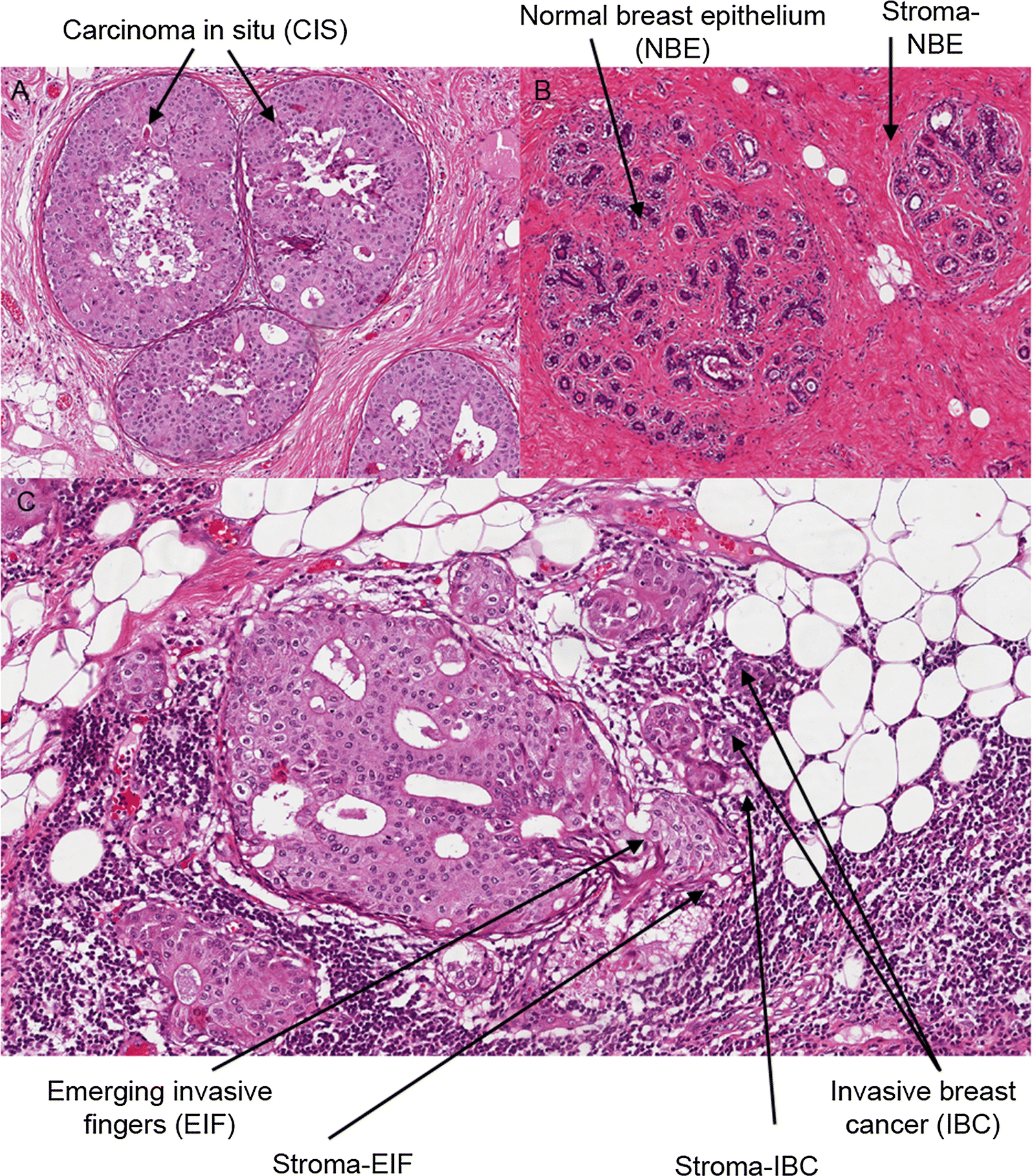 Molecular profiling of microinvasive breast cancer microenvironment ...