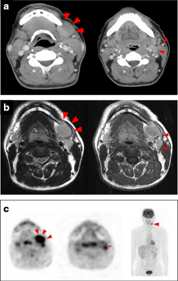 Diagnostic Dilemma Of Igg4 Related Primary Localized Cervical