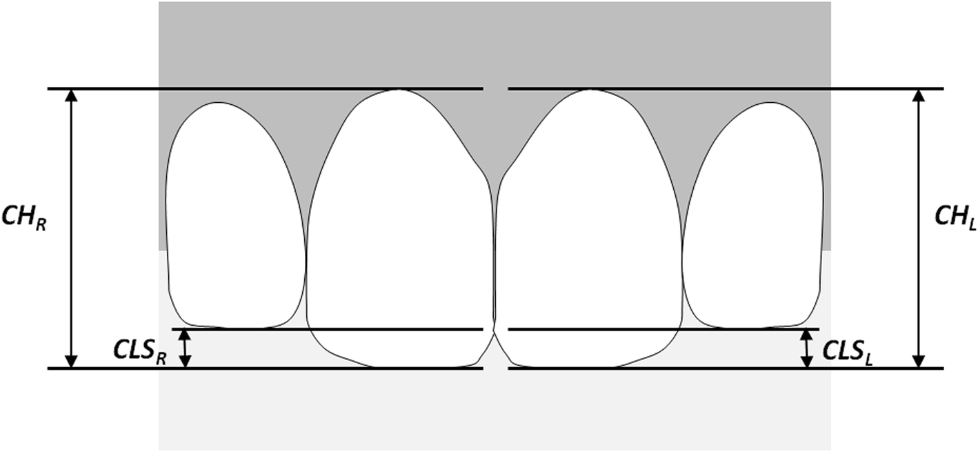 Occlusal height difference between maxillary central and lateral